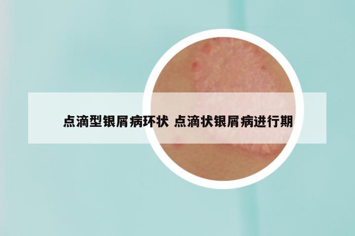 点滴型银屑病环状 点滴状银屑病进行期