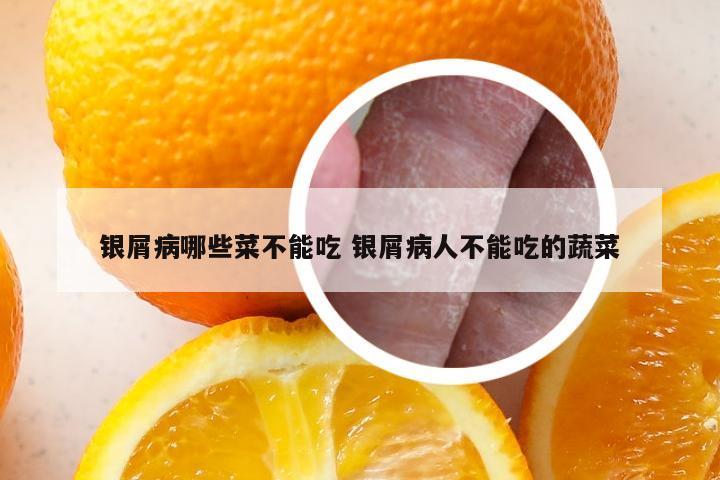 银屑病哪些菜不能吃 银屑病人不能吃的蔬菜