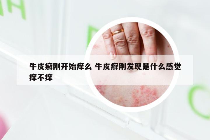 牛皮癣刚开始痒么 牛皮癣刚发现是什么感觉痒不痒