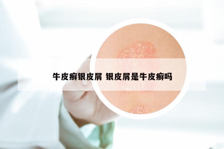 牛皮癣银皮屑 银皮屑是牛皮癣吗