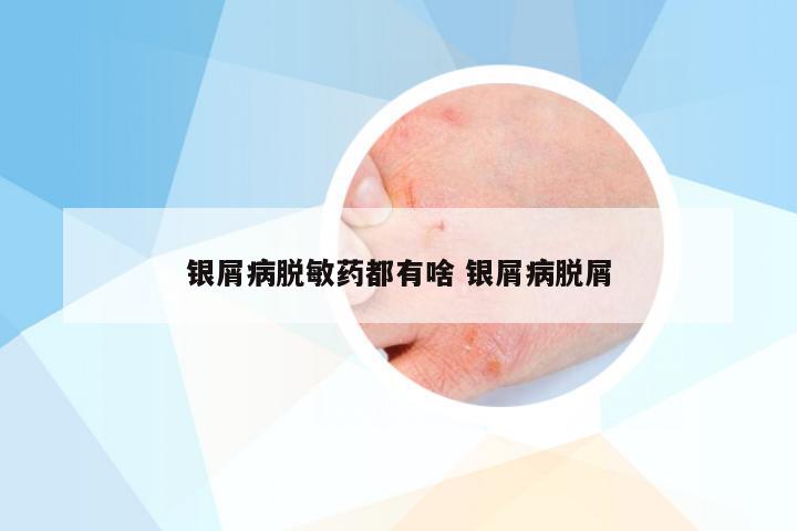 银屑病脱敏药都有啥 银屑病脱屑