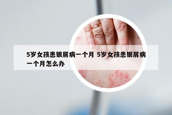 5岁女孩患银屑病一个月 5岁女孩患银屑病一个月怎么办