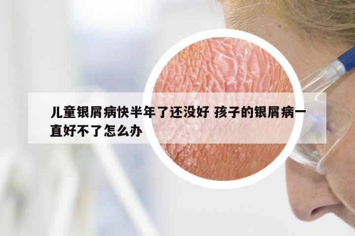 儿童银屑病快半年了还没好 孩子的银屑病一直好不了怎么办