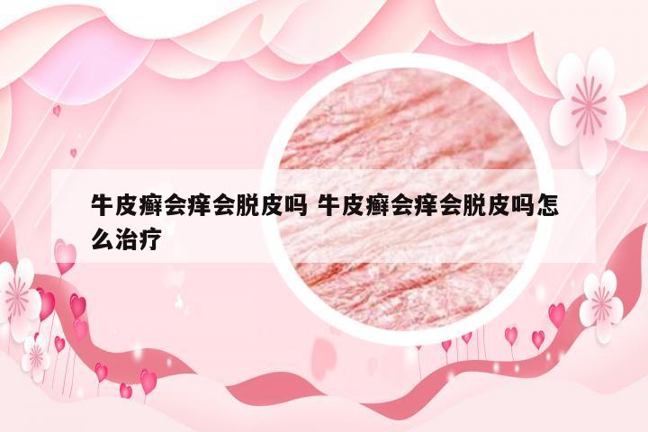 牛皮癣会痒会脱皮吗 牛皮癣会痒会脱皮吗怎么治疗