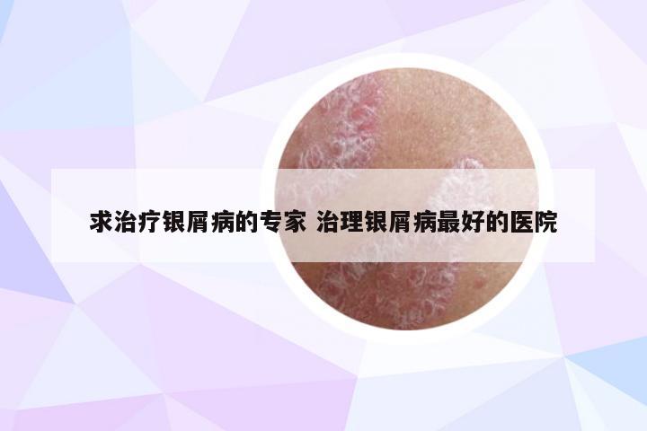 求治疗银屑病的专家 治理银屑病最好的医院