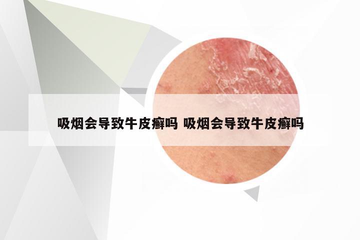 吸烟会导致牛皮癣吗 吸烟会导致牛皮癣吗