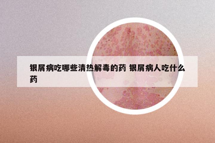 银屑病吃哪些清热解毒的药 银屑病人吃什么药