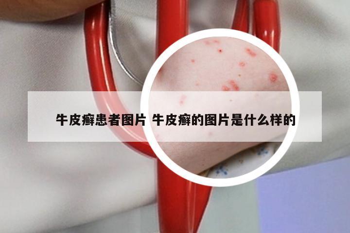 牛皮癣患者图片 牛皮癣的图片是什么样的