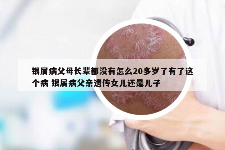 银屑病父母长辈都没有怎么20多岁了有了这个病 银屑病父亲遗传女儿还是儿子