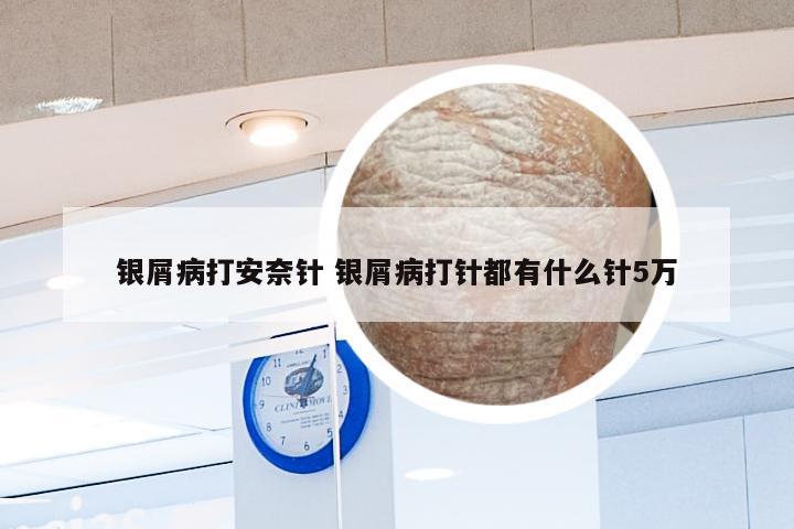 银屑病打安奈针 银屑病打针都有什么针5万