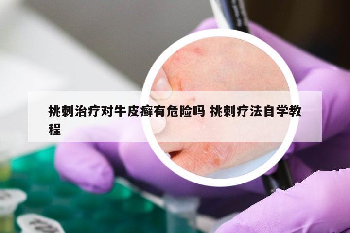 挑刺治疗对牛皮癣有危险吗 挑刺疗法自学教程