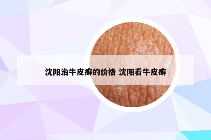 沈阳治牛皮癣的价格 沈阳看牛皮癣