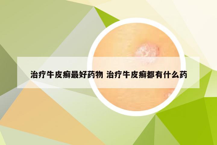 治疗牛皮癣最好药物 治疗牛皮癣都有什么药