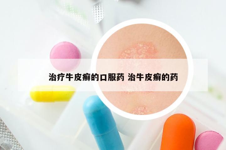 治疗牛皮癣的口服药 治牛皮癣的药