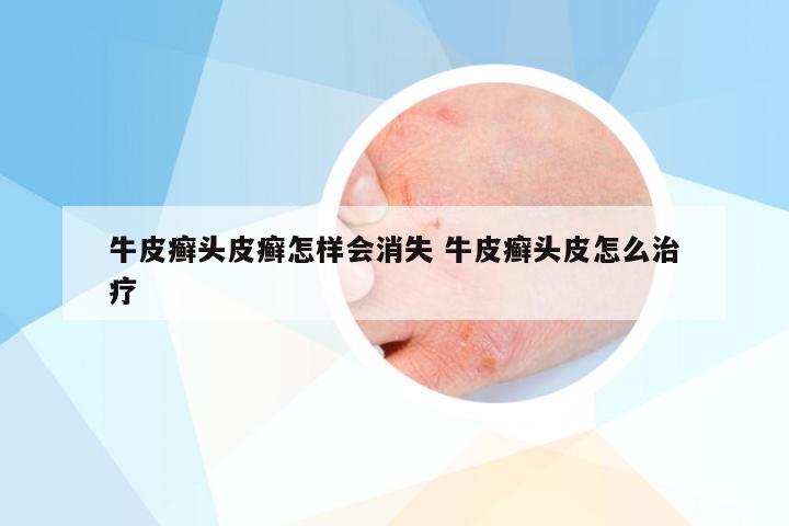 牛皮癣头皮癣怎样会消失 牛皮癣头皮怎么治疗