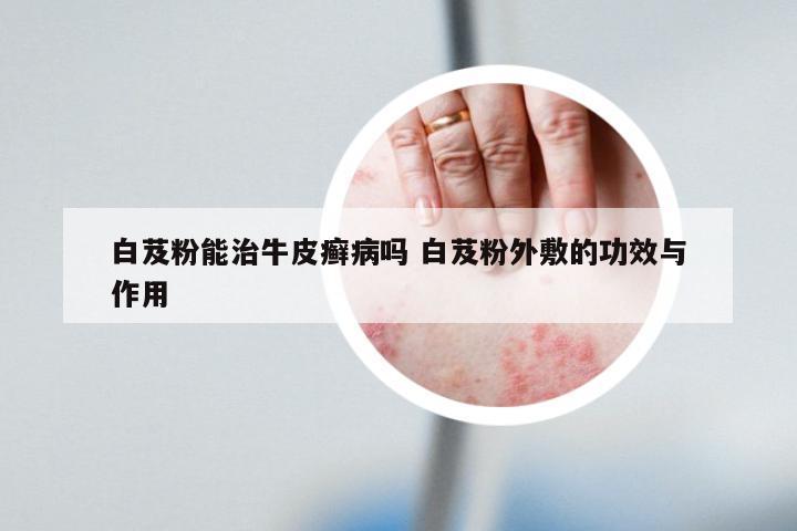 白芨粉能治牛皮癣病吗 白芨粉外敷的功效与作用