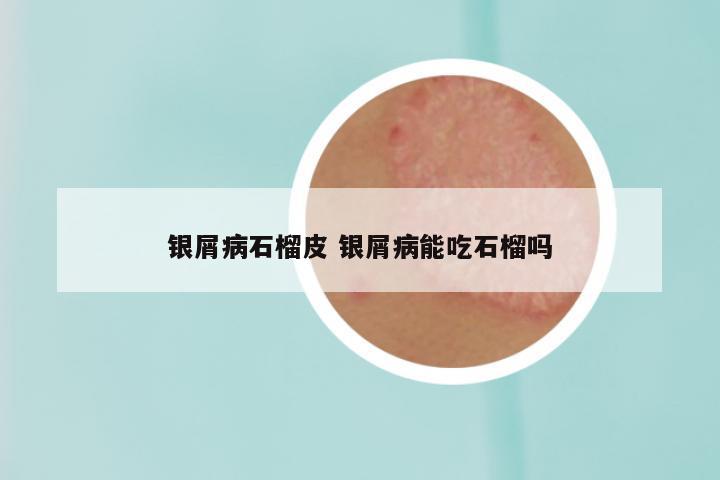 银屑病石榴皮 银屑病能吃石榴吗