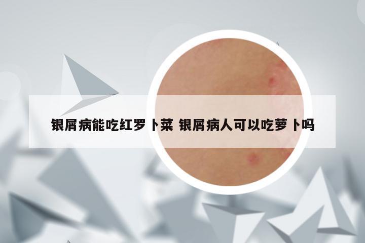 银屑病能吃红罗卜菜 银屑病人可以吃萝卜吗