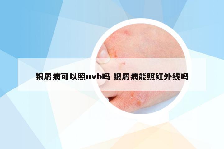 银屑病可以照uvb吗 银屑病能照红外线吗