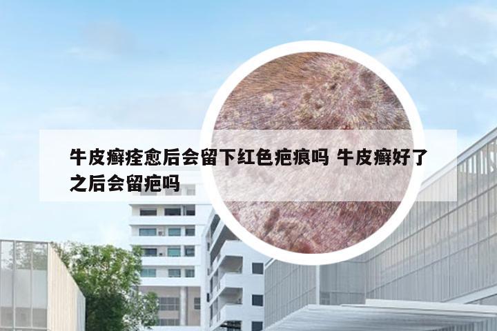 牛皮癣痊愈后会留下红色疤痕吗 牛皮癣好了之后会留疤吗
