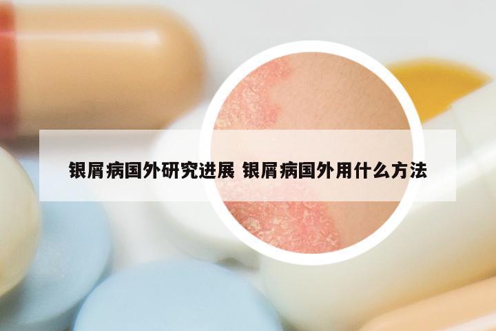 银屑病国外研究进展 银屑病国外用什么方法