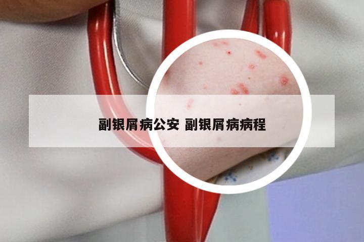 副银屑病公安 副银屑病病程