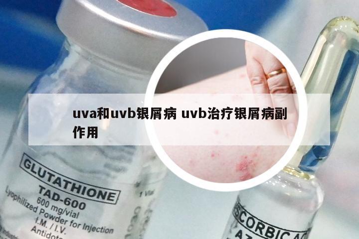 uva和uvb银屑病 uvb治疗银屑病副作用