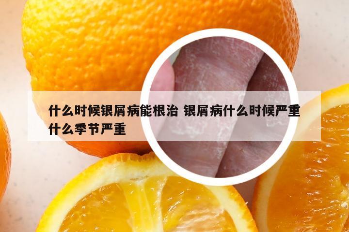 什么时候银屑病能根治 银屑病什么时候严重什么季节严重