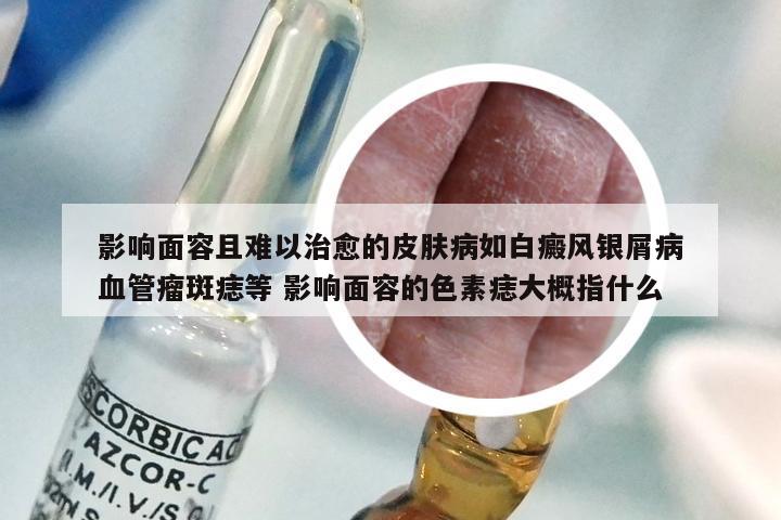 影响面容且难以治愈的皮肤病如白癜风银屑病血管瘤斑痣等 影响面容的色素痣大概指什么