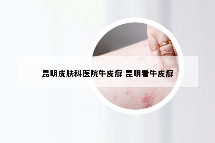 昆明皮肤科医院牛皮癣 昆明看牛皮癣