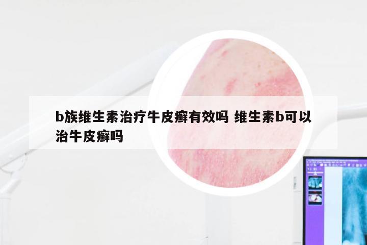 b族维生素治疗牛皮癣有效吗 维生素b可以治牛皮癣吗