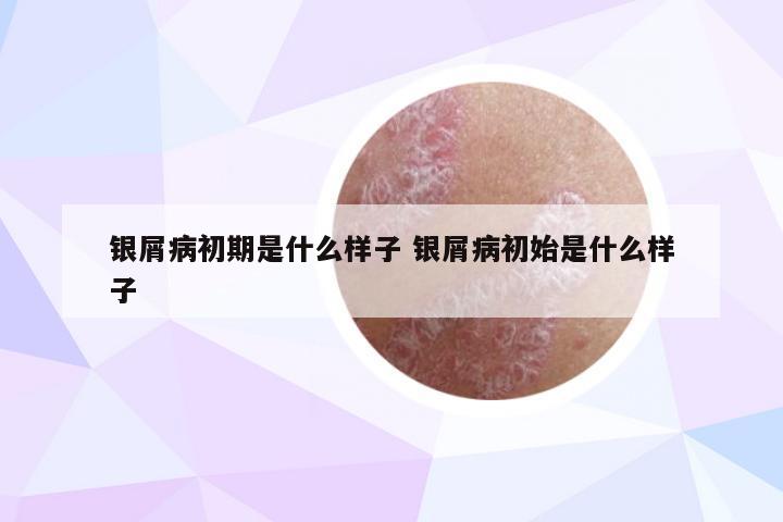 银屑病初期是什么样子 银屑病初始是什么样子