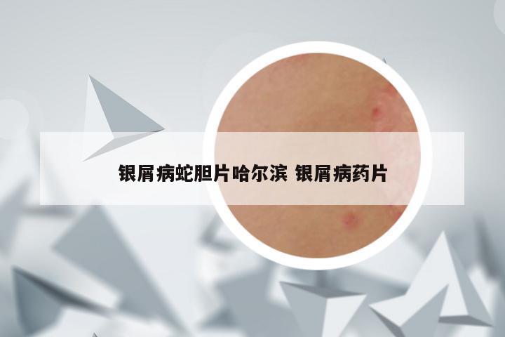 银屑病蛇胆片哈尔滨 银屑病药片