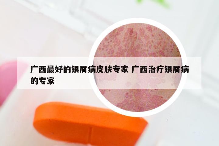 广西最好的银屑病皮肤专家 广西治疗银屑病的专家