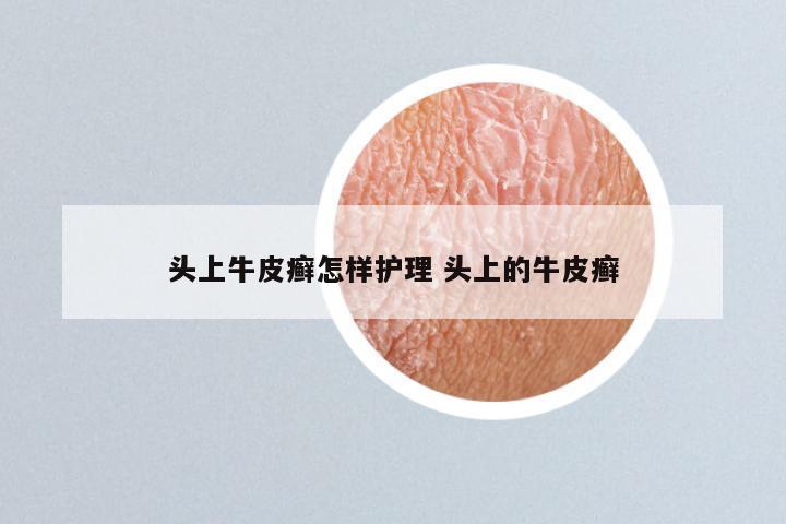 头上牛皮癣怎样护理 头上的牛皮癣