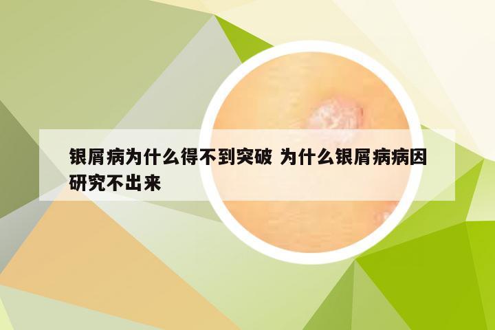 银屑病为什么得不到突破 为什么银屑病病因研究不出来