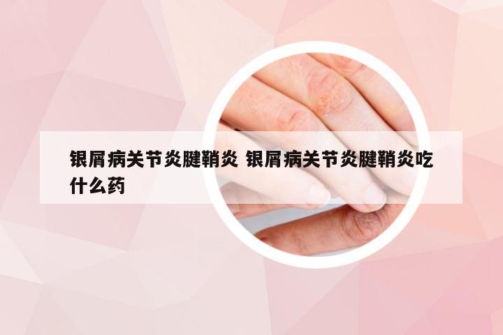 银屑病关节炎腱鞘炎 银屑病关节炎腱鞘炎吃什么药
