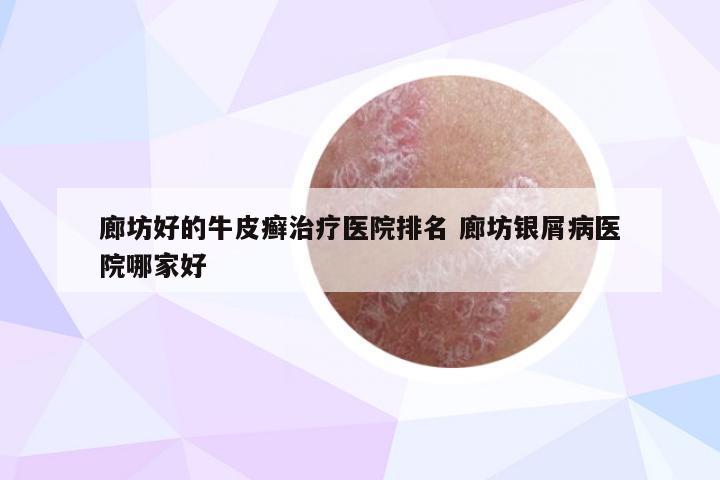 廊坊好的牛皮癣治疗医院排名 廊坊银屑病医院哪家好
