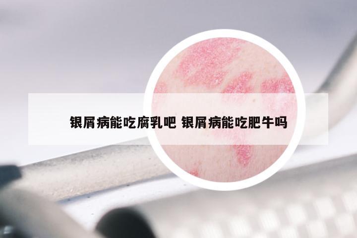 银屑病能吃腐乳吧 银屑病能吃肥牛吗