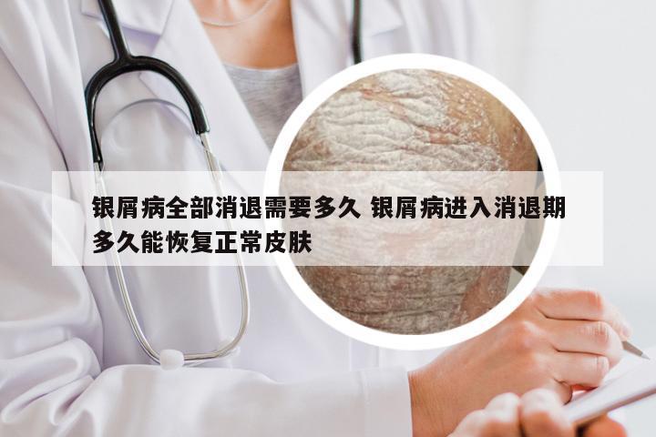 银屑病全部消退需要多久 银屑病进入消退期多久能恢复正常皮肤