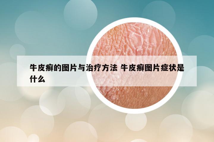 牛皮癣的图片与治疗方法 牛皮癣图片症状是什么