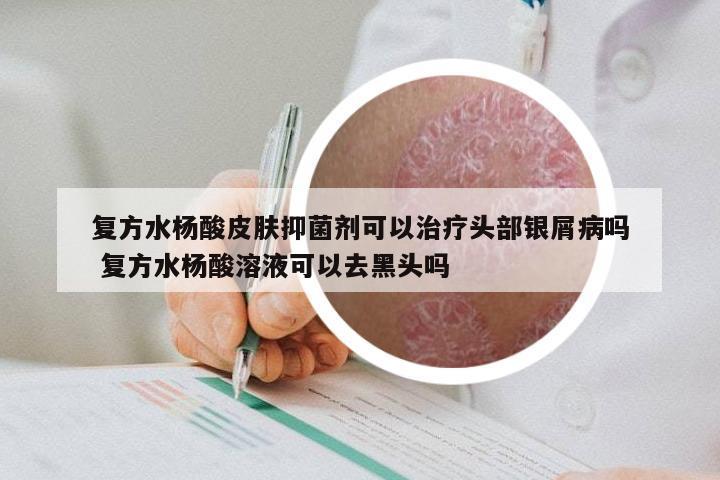 复方水杨酸皮肤抑菌剂可以治疗头部银屑病吗 复方水杨酸溶液可以去黑头吗