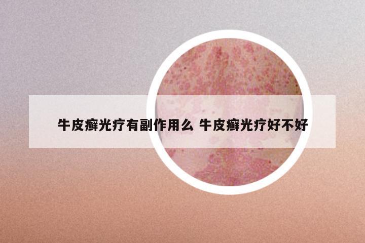 牛皮癣光疗有副作用么 牛皮癣光疗好不好