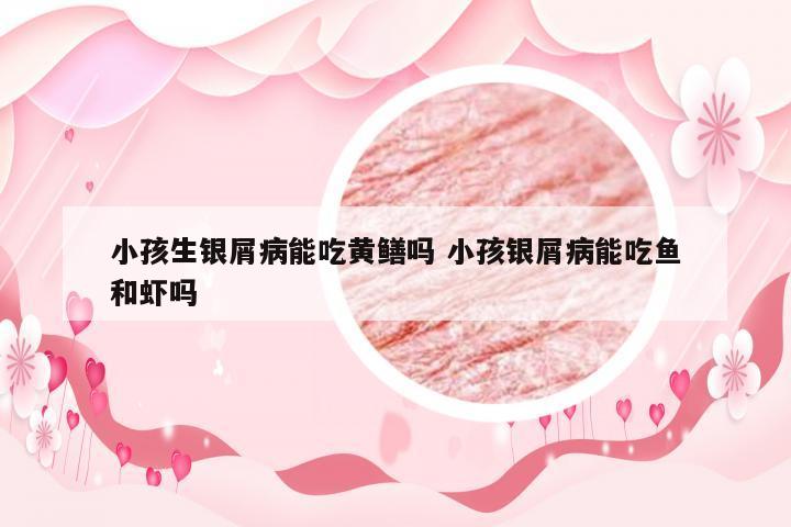 小孩生银屑病能吃黄鳝吗 小孩银屑病能吃鱼和虾吗