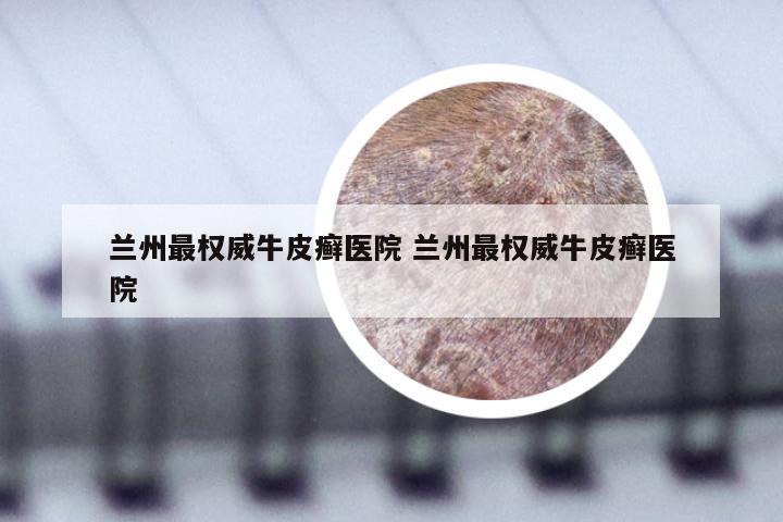 兰州最权威牛皮癣医院 兰州最权威牛皮癣医院
