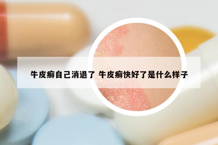 牛皮癣自己消退了 牛皮癣快好了是什么样子