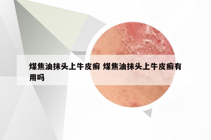 煤焦油抹头上牛皮癣 煤焦油抹头上牛皮癣有用吗
