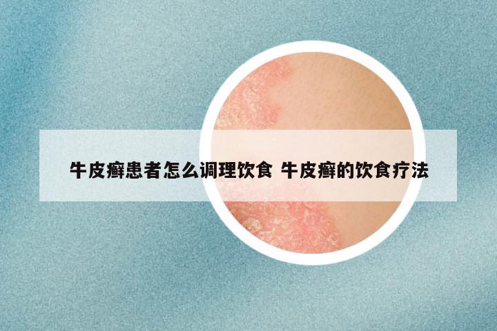 牛皮癣患者怎么调理饮食 牛皮癣的饮食疗法