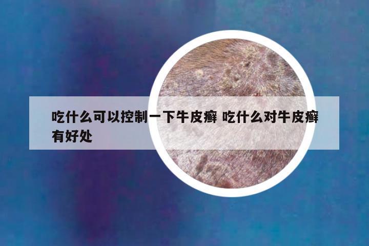 吃什么可以控制一下牛皮癣 吃什么对牛皮癣有好处