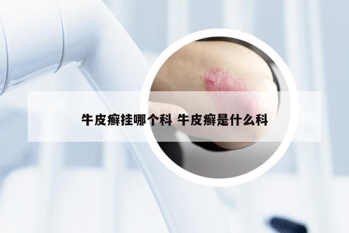 牛皮癣挂哪个科 牛皮癣是什么科